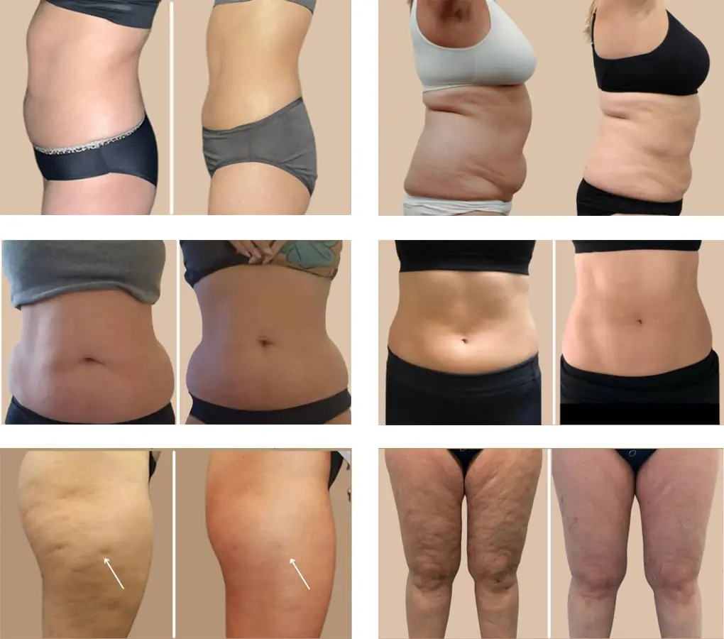 Pluse-shape_EMS-Details-11