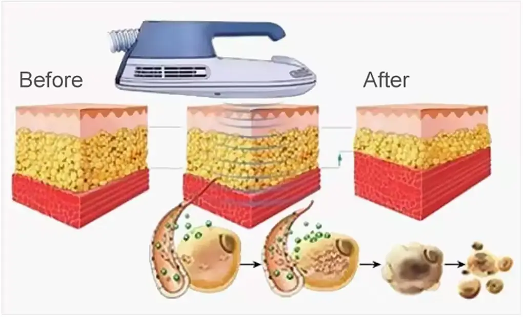 Pluse-shape_EMS-Details-3