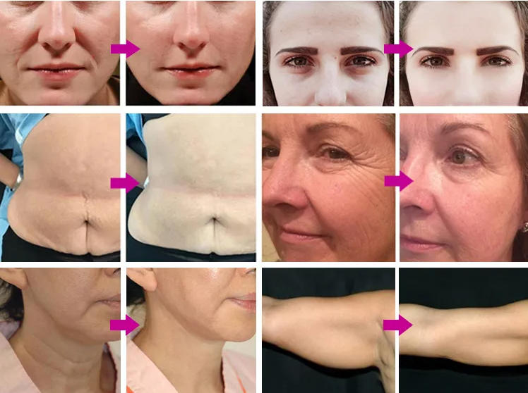 portable 4 in 1 ice smas hifu cold hammer body slimming vmax antiaging micro needle face lifting morpheus 8 fractional machine