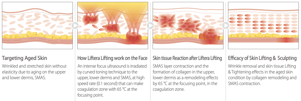 portable 4 in 1 ice smas hifu cold hammer body slimming vmax antiaging micro needle face lifting morpheus 8 fractional machine