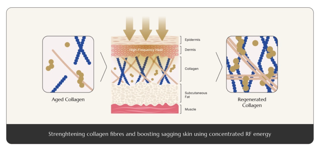 facial rf cavitation facial hifu and body rf dual cavitation 6 in 1 beauty machine