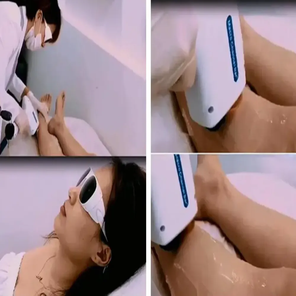 diode laser hair removal dark skin