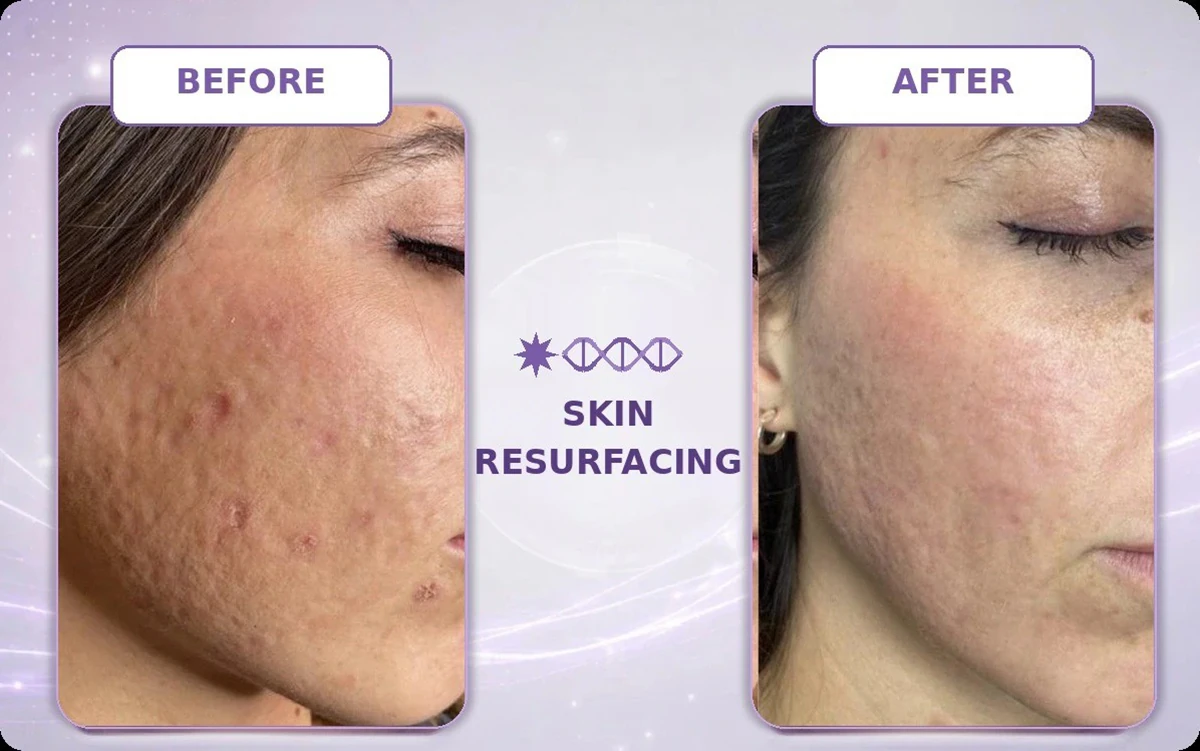 femimed plus — 75w high power fractional co₂ laser
