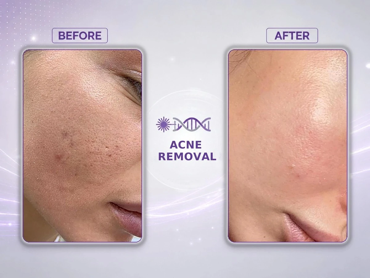 femimed pro professional fractional co₂ laser