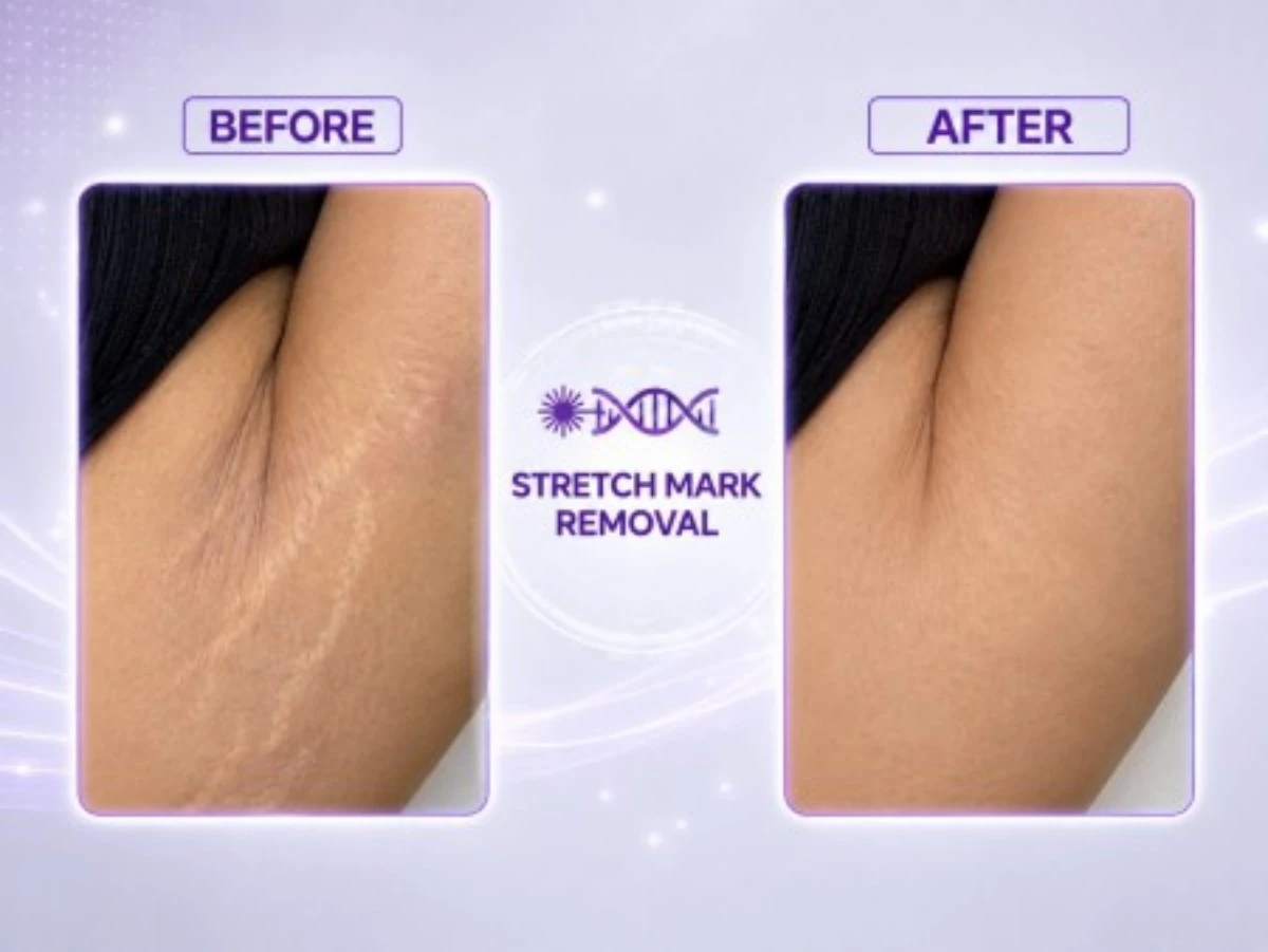 femimed pro professional fractional co₂ laser
