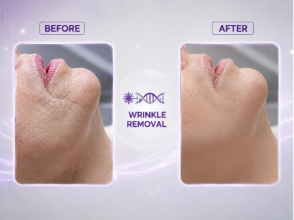 femimed pro professional fractional co₂ laser