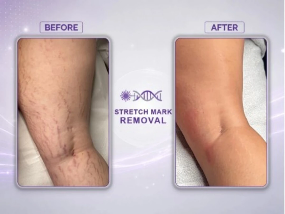 femimed pro professional fractional co₂ laser