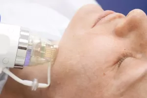 how does rf microneedling achieve skin rejuvenation and reduce dark circlesbanner