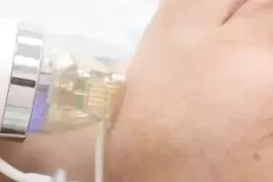 micro needling rf faqs banner